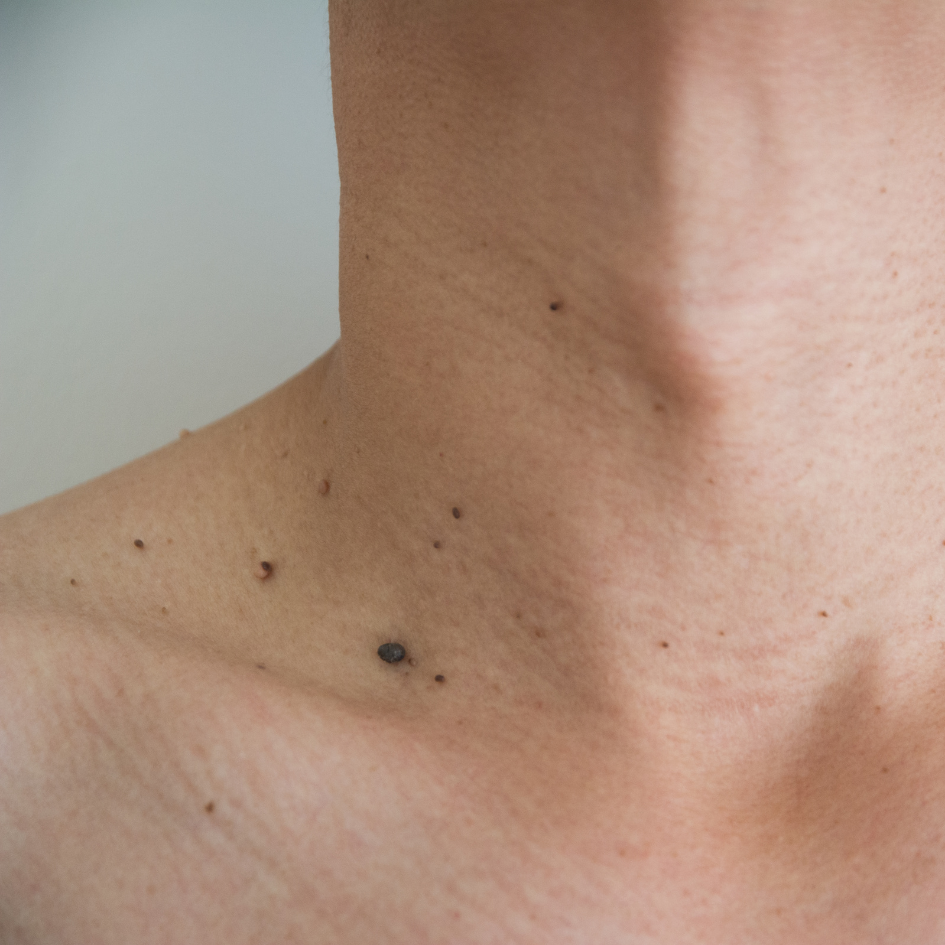 Eliminación de Verrugas